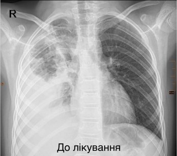 Львівські хірурги врятували 7-річну дівчинку з важкою деструктивною пневмонією